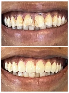 Porcelain veneers before and after: broken-down, discolored upper front teeth (top) and natural-looking veneers (bottom), Diamond Dental, Beachwood, OH