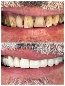 Porcelain veneers before and after: stained, worn upper front teeth (top) and the finished even white smile (bottom), Diamond Dental, Beachwood, OH