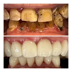 Smile makeover before and after: badly worn, decayed teeth (top) rebuilt into a full, even smile (bottom), Diamond Dental, Beachwood, OH