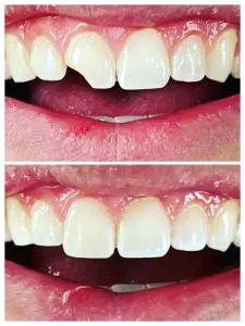 Veneer before and after: chipped upper front tooth (top) restored to match the tooth beside it (bottom), Diamond Dental, Beachwood, OH