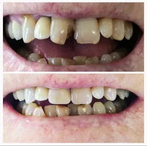 Veneers before and after: chipped, uneven upper front teeth (top) and the more even result (bottom), Diamond Dental, Beachwood, OH